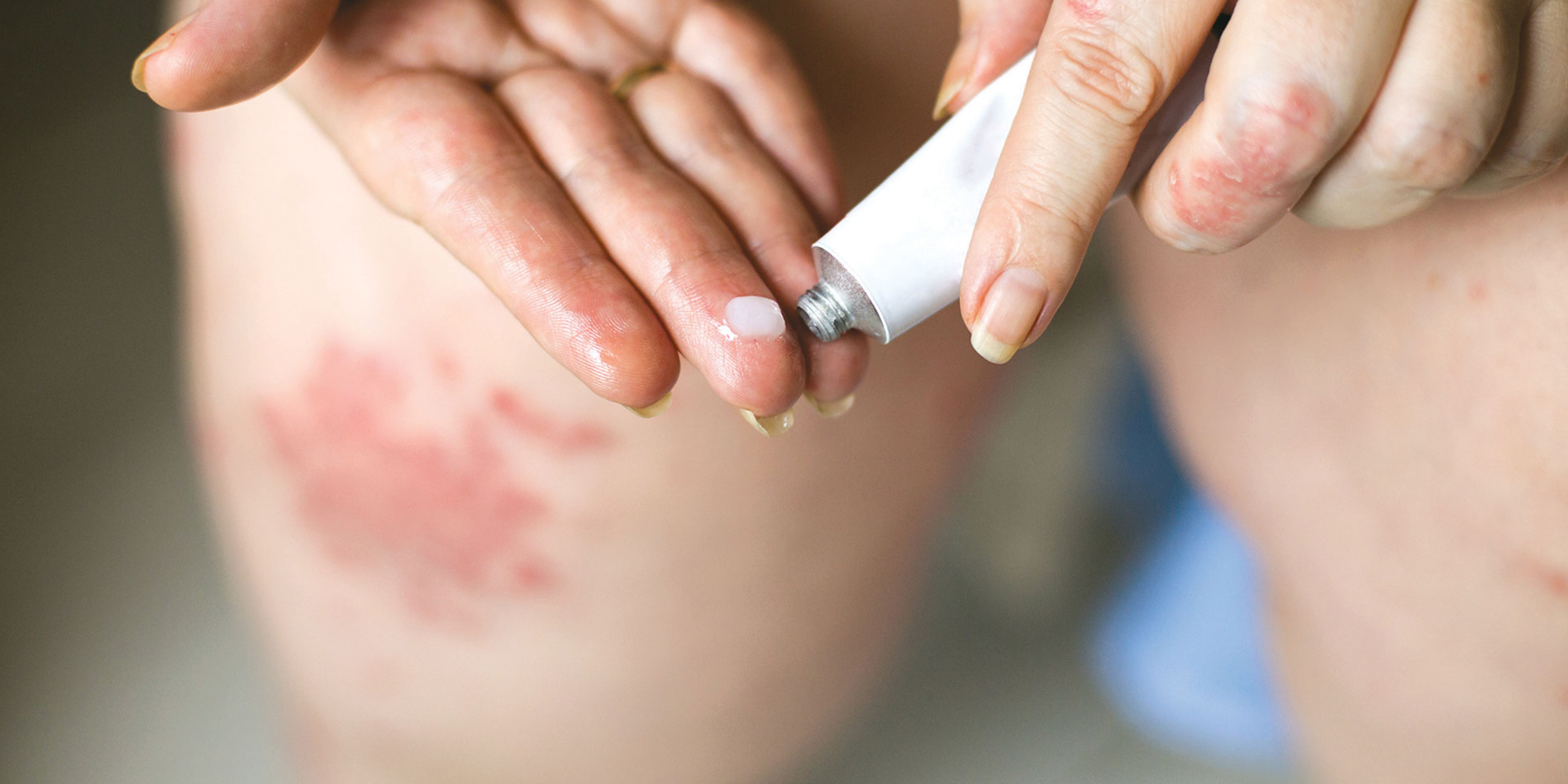 A picture of someone with patches of eczema squeezing medicine onto their fingertips.